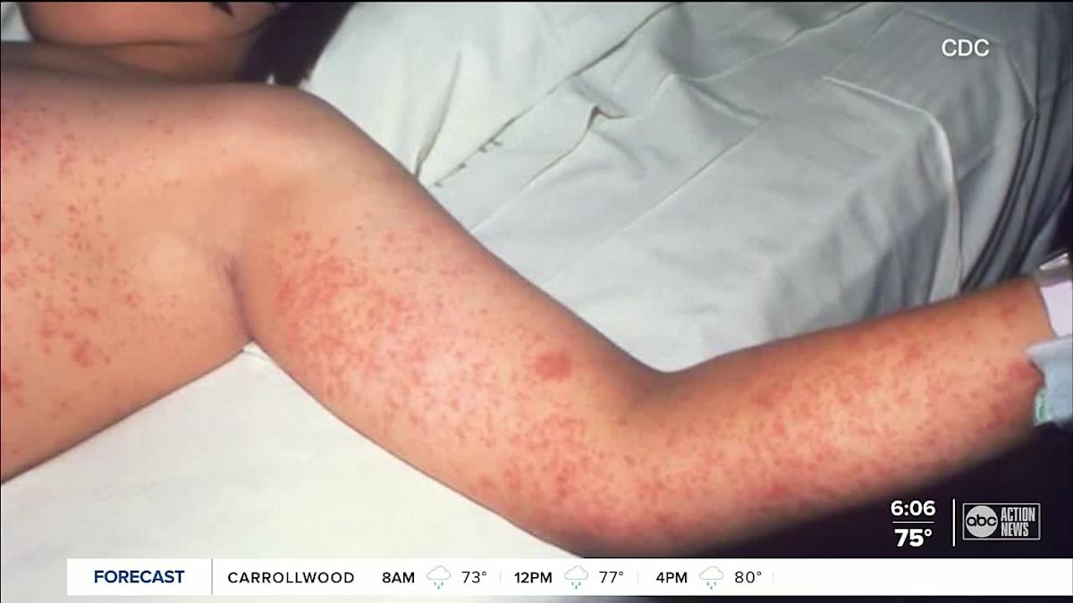 Travel Plans This Summer? Be Aware Of The Increased Measles Risk Travel Plans This Summer? Be Aware Of The Increased Measles Risk